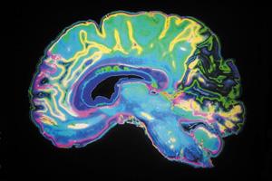 Retirement Lifestyle: Alzheimer’s Pre-Testing